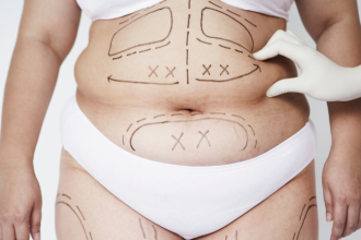 Milton Seigi Hayashi destaca como as novas tecnologias permitem resultados mais precisos e esculturais na lipo HD.