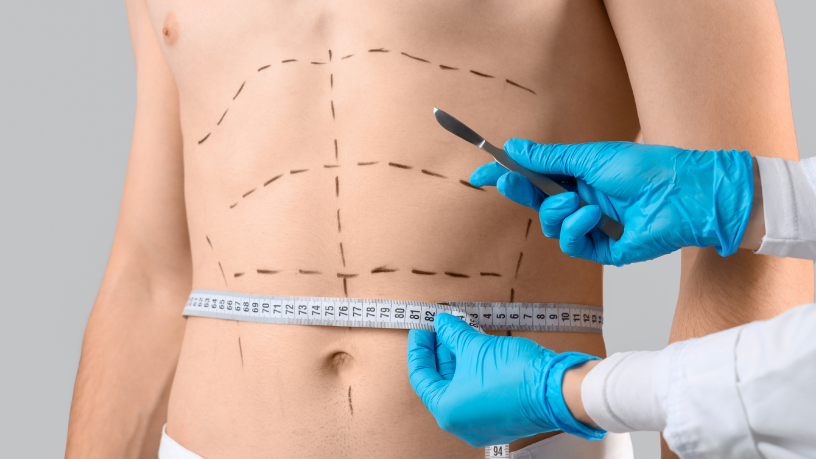 Para Dr. Haeckel Cabral, a abdominoplastia moderna prioriza segurança, realismo e resultados duradouros.